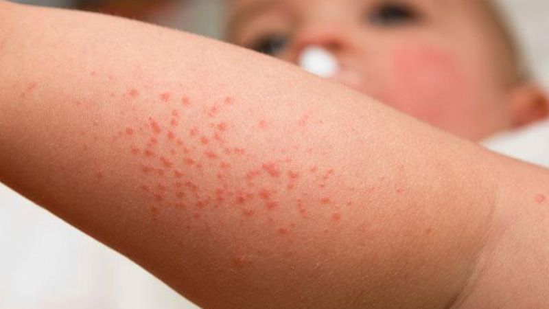 Cuidados De La Dermatitis Atópica (eczema)