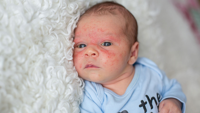 La Dermatitis Atópica En Niños Es Una Antesala Del Asma Y Rinitis Alérgica
